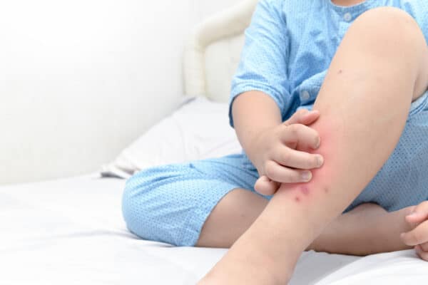 Hand scratching ,legs of fat boy with swelling spot ,sore and scar from mosquitoes bite allergy, Health care concept